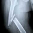 Bone Healing