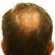 Hair Loss