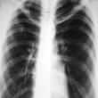Tuberculosis