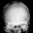 Craniofrontonasal syndrome