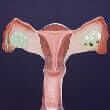 Ovarian cancer