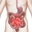 Irritable Bowel Syndrome