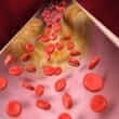 Arteriosclerosis