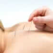 Acupuncture