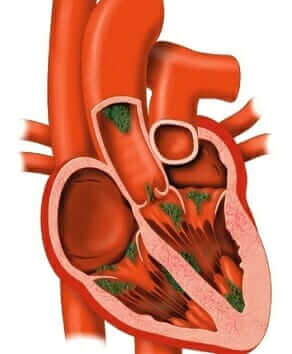 Mitral valve prolapse