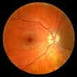 Retinopathy