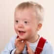 Down syndrome