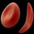 Sickle cell disease