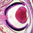 Retinitis pigmentosa (RP)