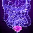 Bladder cancer